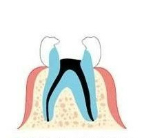 桂林做根管治疗多少钱 牙齿做根管治疗步骤