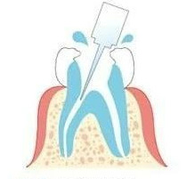 桂林做根管治疗多少钱 牙齿矫正无托槽隐形矫治器