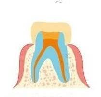 桂林做根管治疗多少钱 牙齿做根管治疗步骤