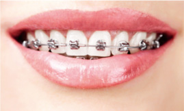 桂林纠正牙齿多少钱 金属托槽矫正分哪几种牙
