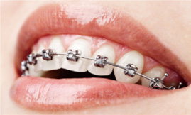 桂林纠正牙齿多少钱 12岁矫正牙金属自锁托槽